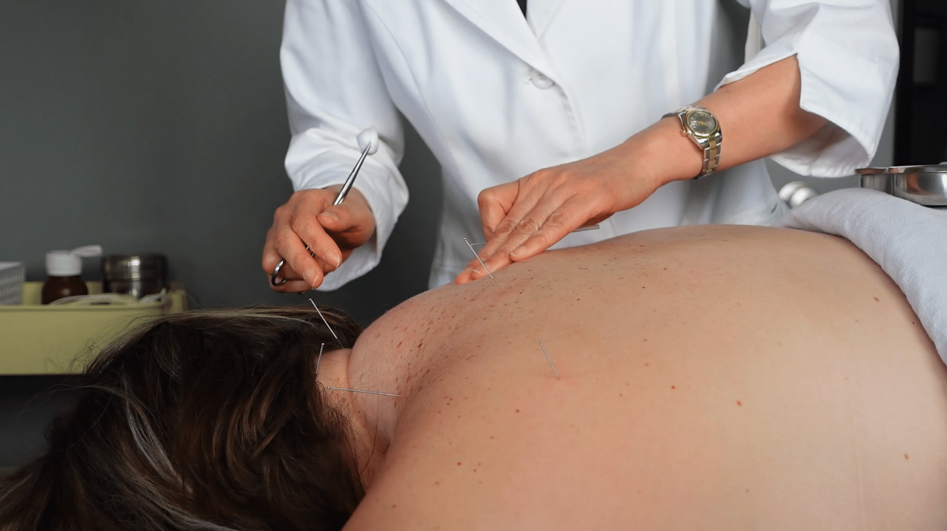 Acupuncture in Winnipeg
